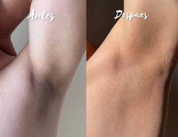 Antes y Despu&eacute;s - Axilas